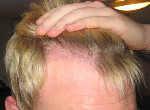 Maschere per capelli da senape e olio di ricino